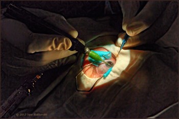 RGB в офтальмологической  микрохирургии 
